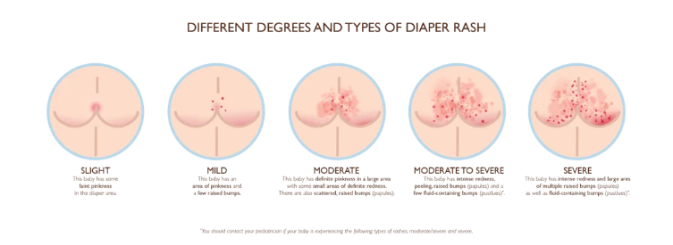 Green Giantz: A Breath of Fresh Air for Incontinence Rashes and Bliste